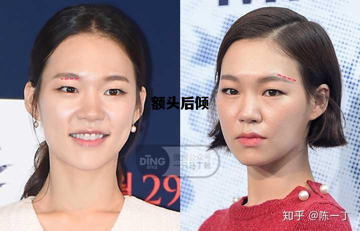 额头后倾，侧脸额头后倾