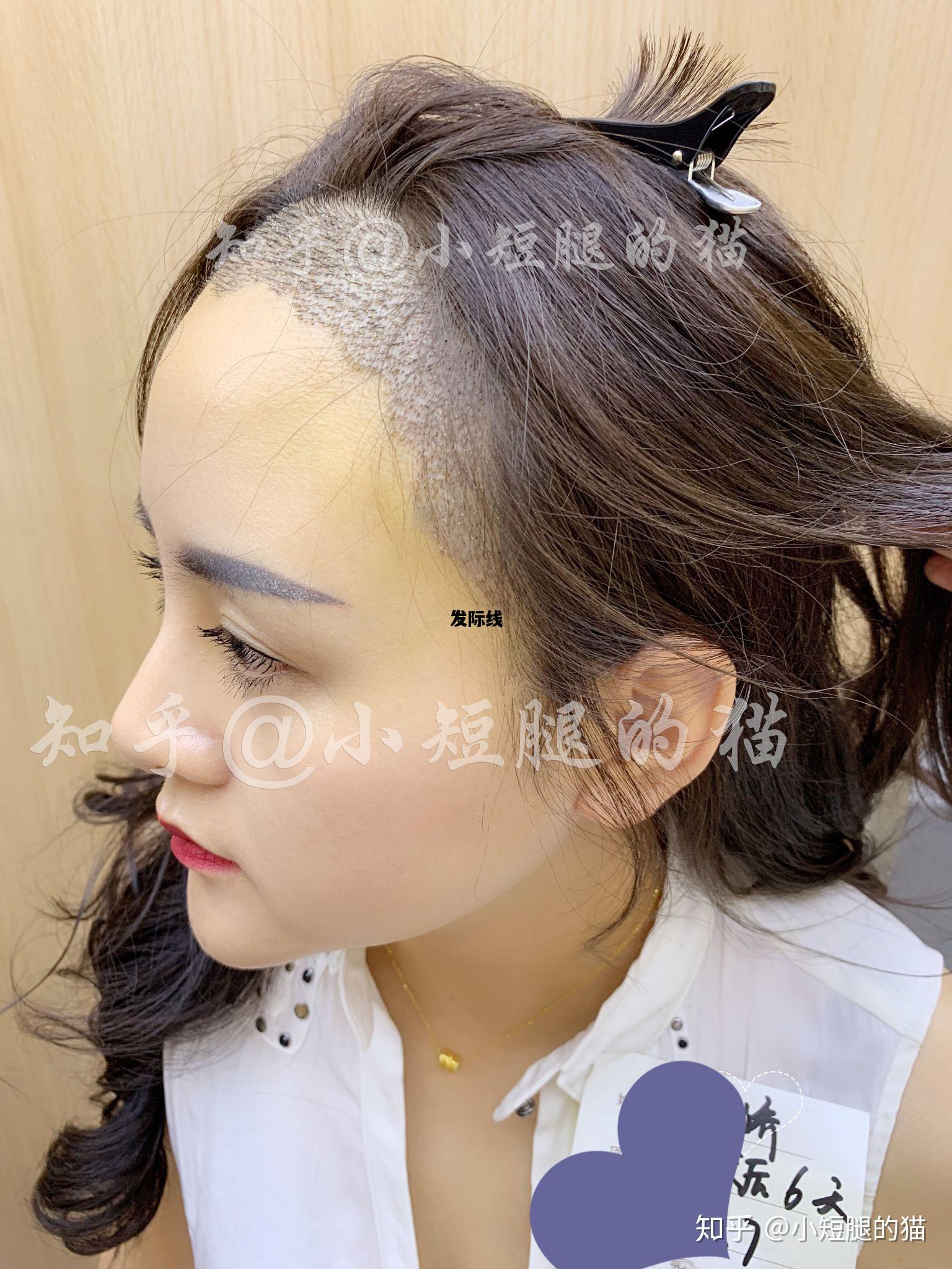 发际线，发际线植发多少钱