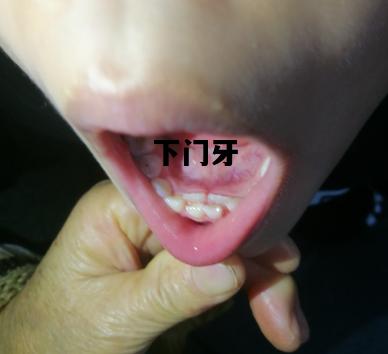 下门牙，下门牙松动疼痛怎么办