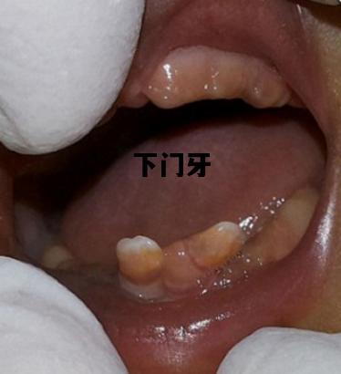 下门牙，下门牙松动疼痛怎么办