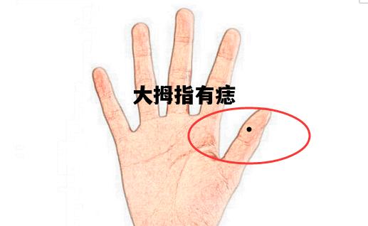 大拇指有痣，大拇指有痣代表什么女