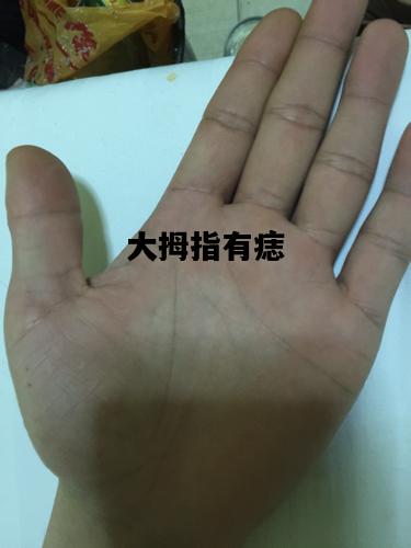 大拇指有痣，大拇指有痣代表什么女