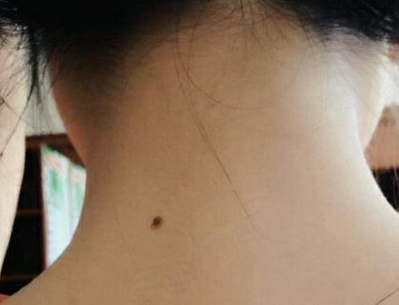 女人后背的痣的命运图，女人10处有痣是富贵痣