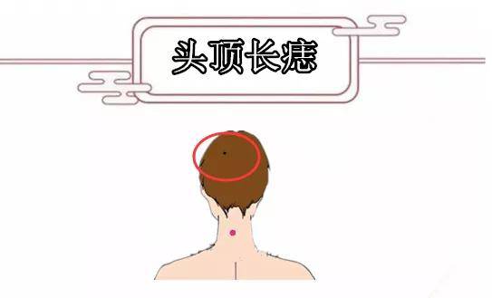 头上有痣，头上有痣代表什么 男人