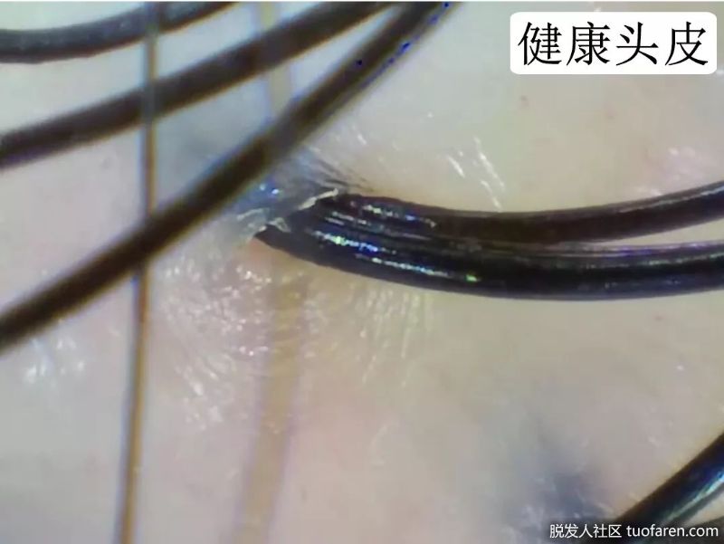 毛囊图片，正常头发毛囊图片