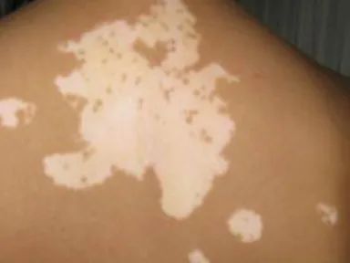 胎记的由来，胎记是从何而来